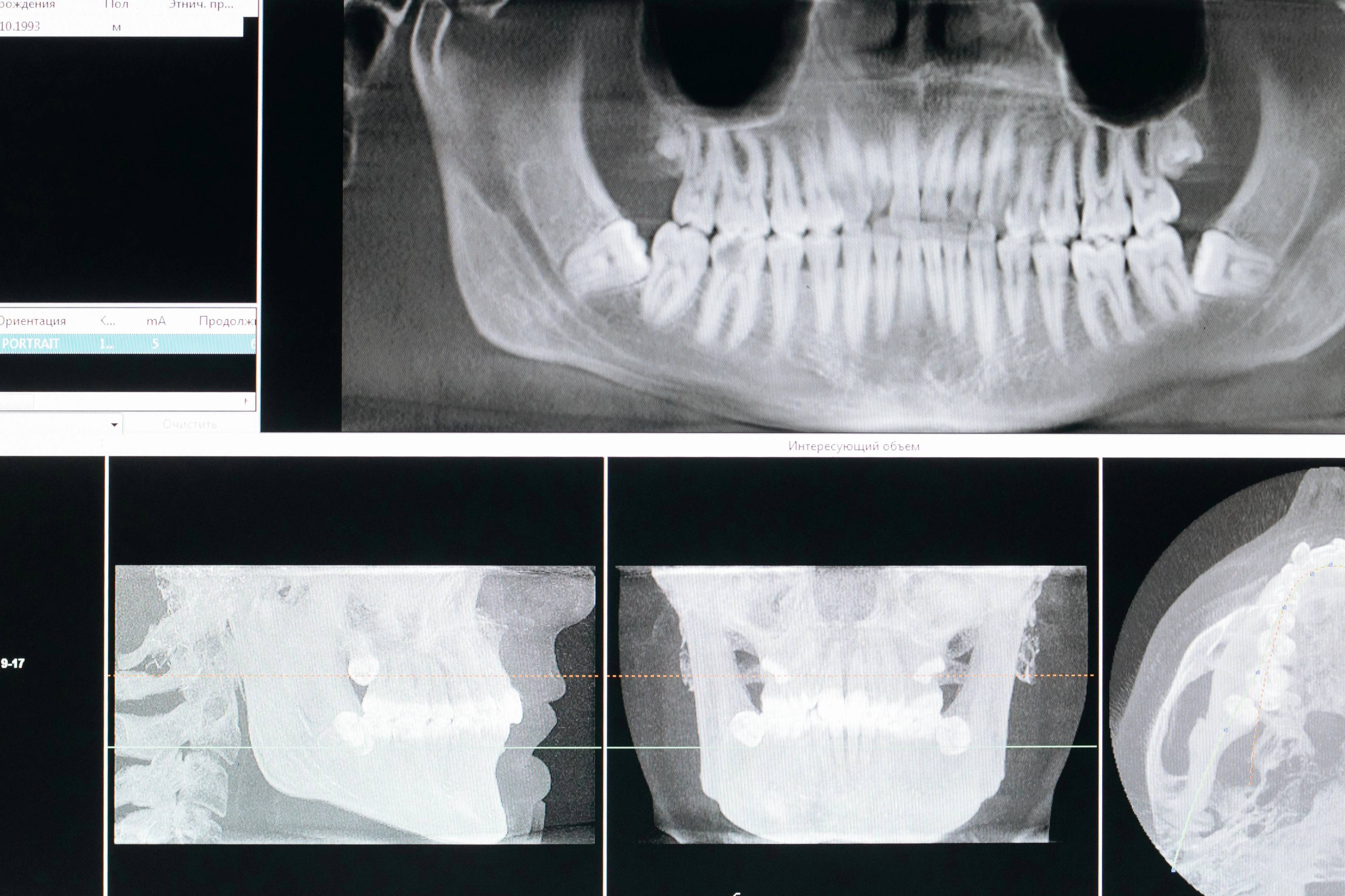 dental x-ray showing patients mouth and teeth