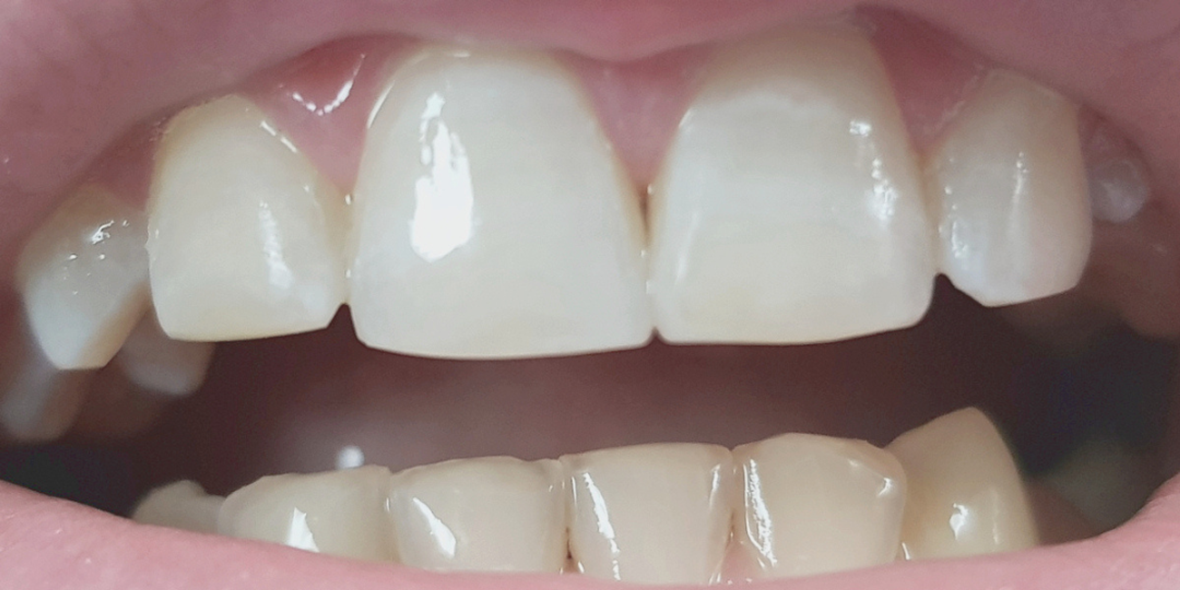 composite bonding case after