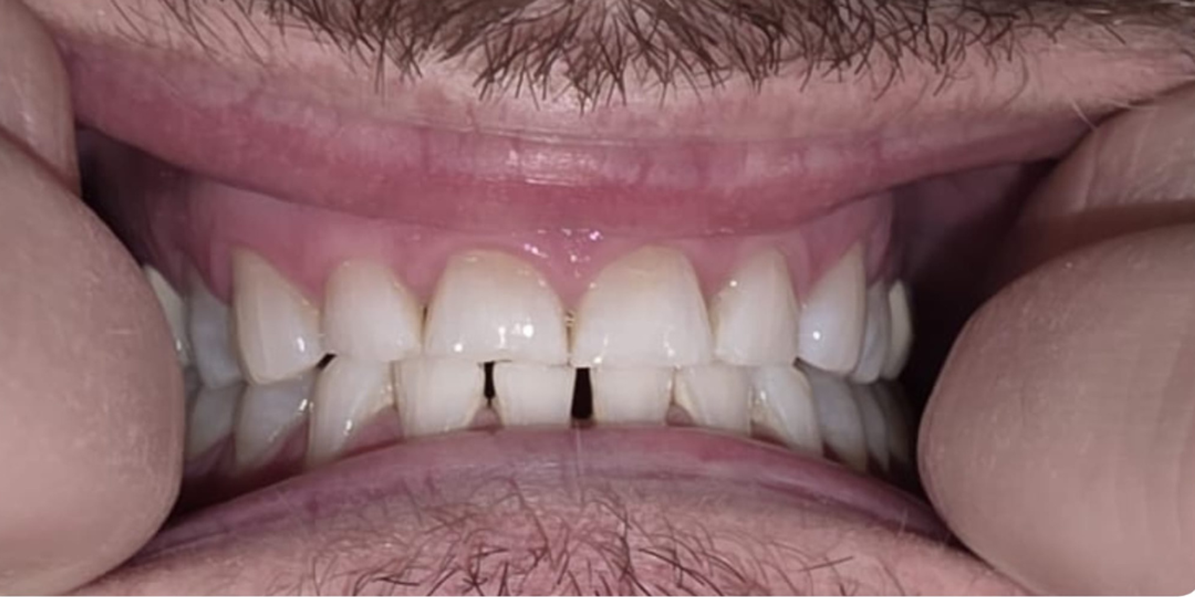 teeth whitened after treatment results