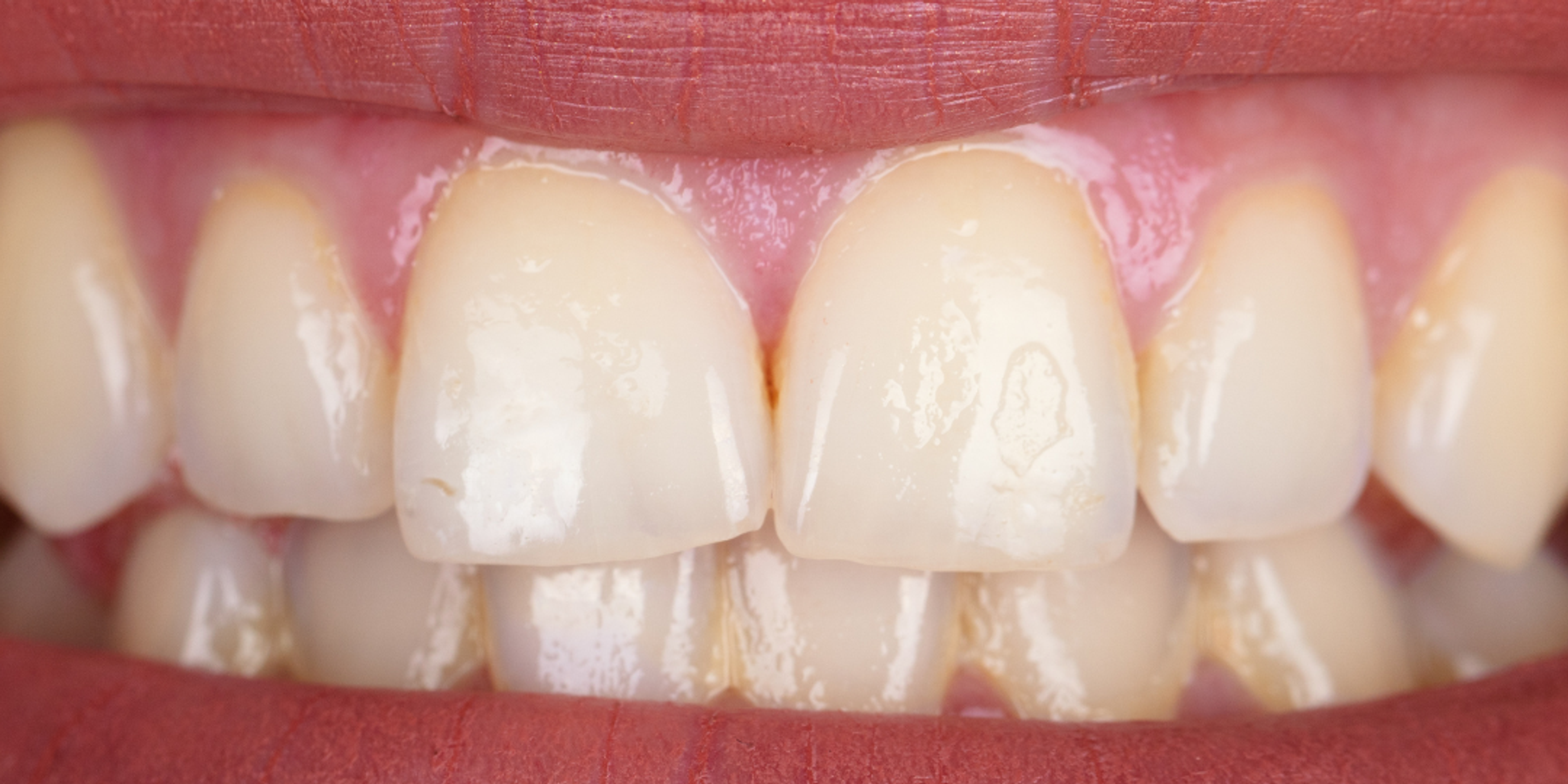 teeth whitening before