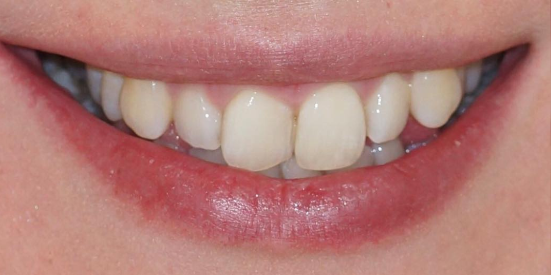 Invisalign before