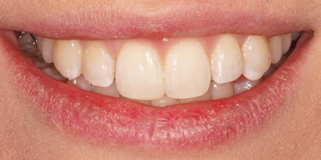 Invisalign after