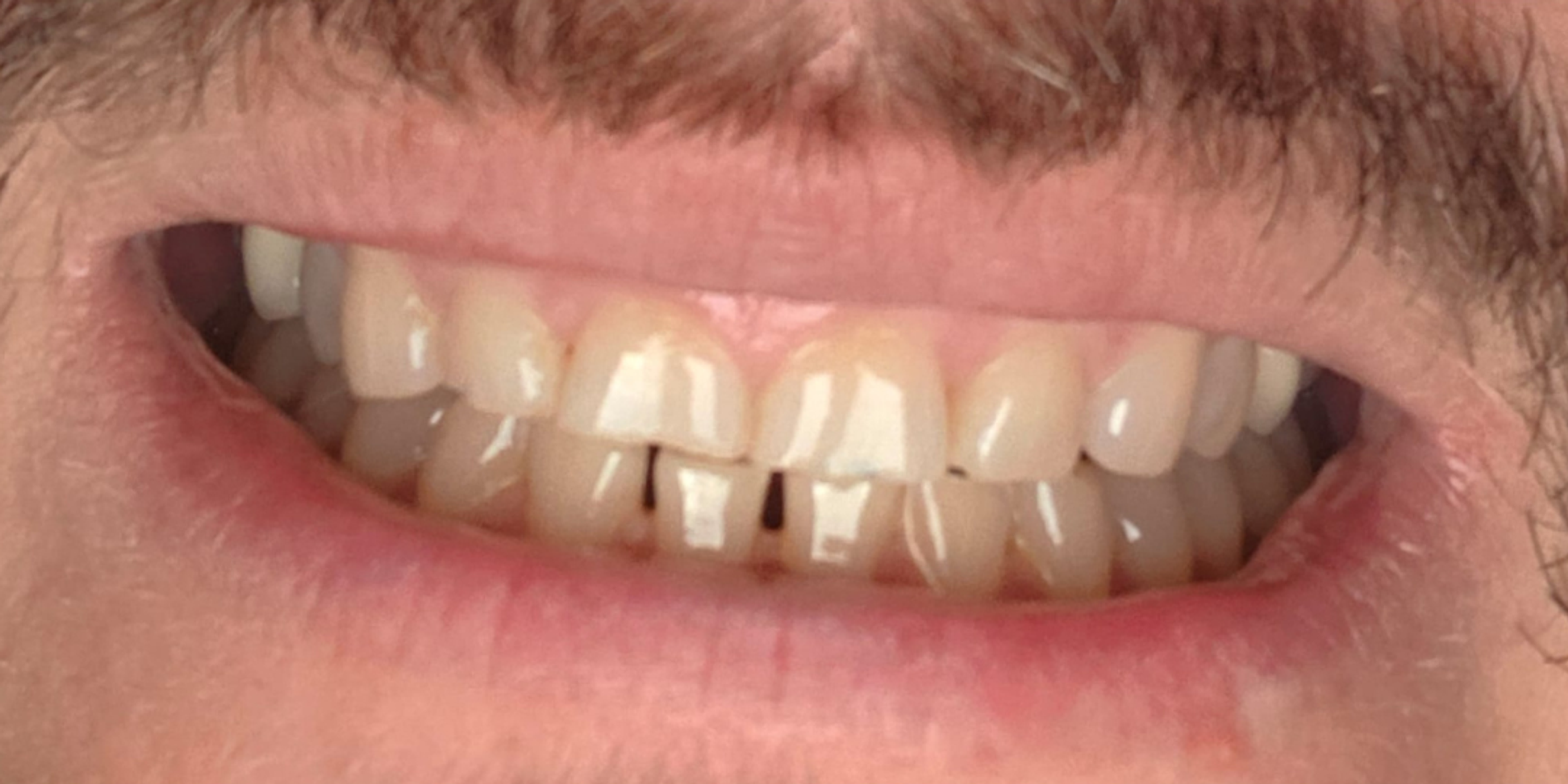 teeth whitening before