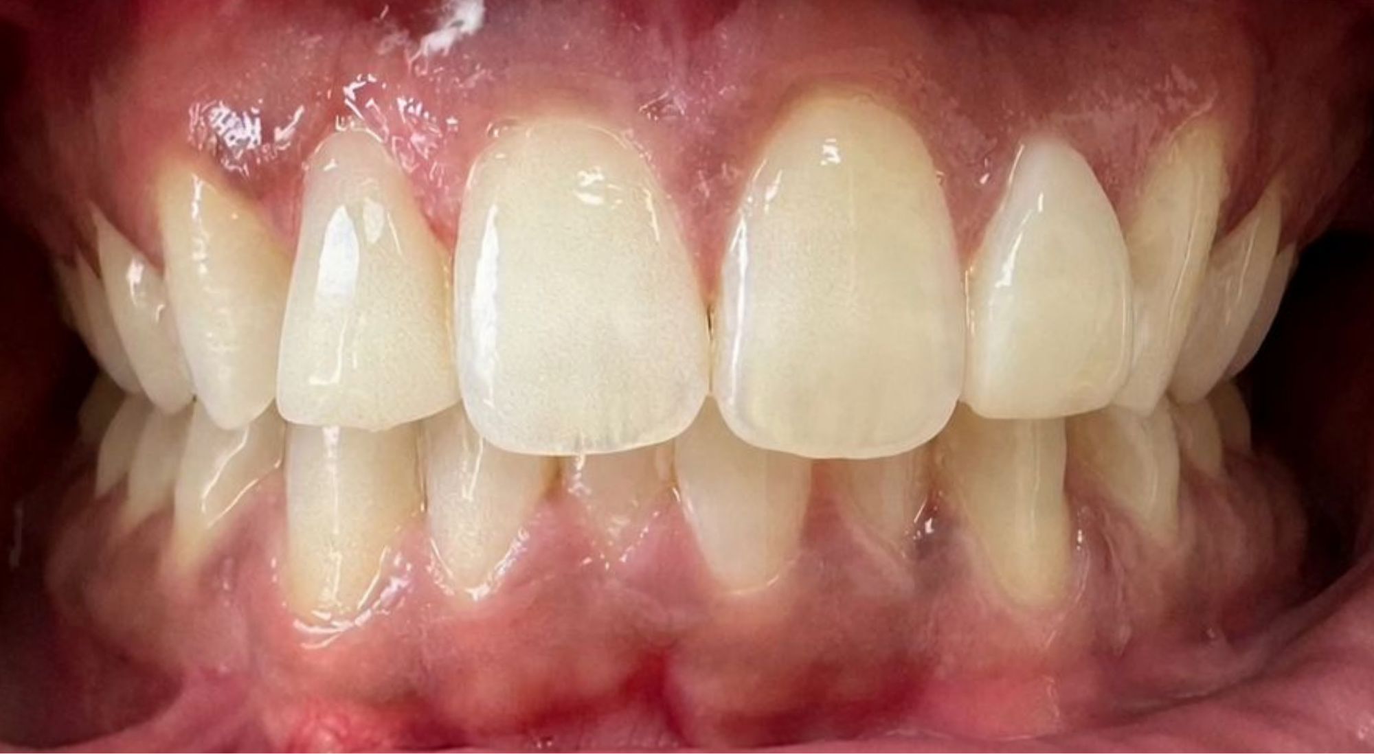 composite bonding case after