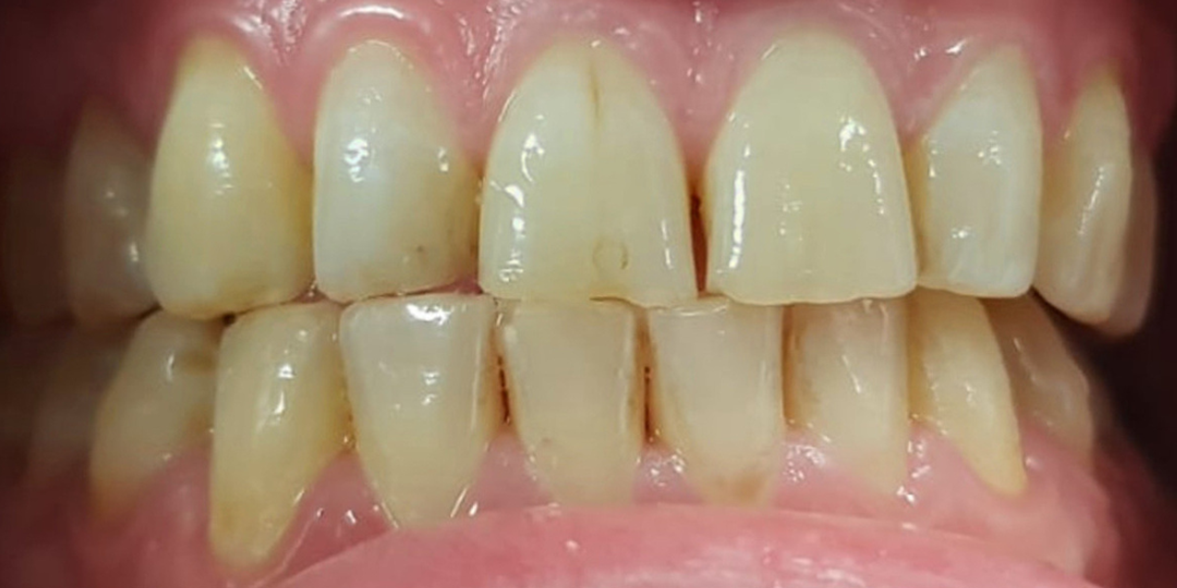 teeth whitening before