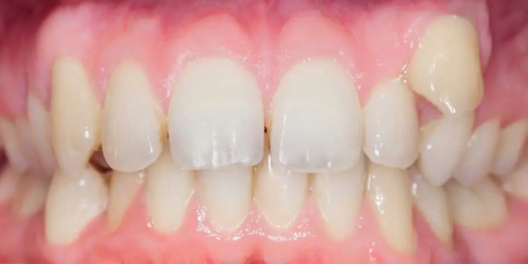 Invisalign before
