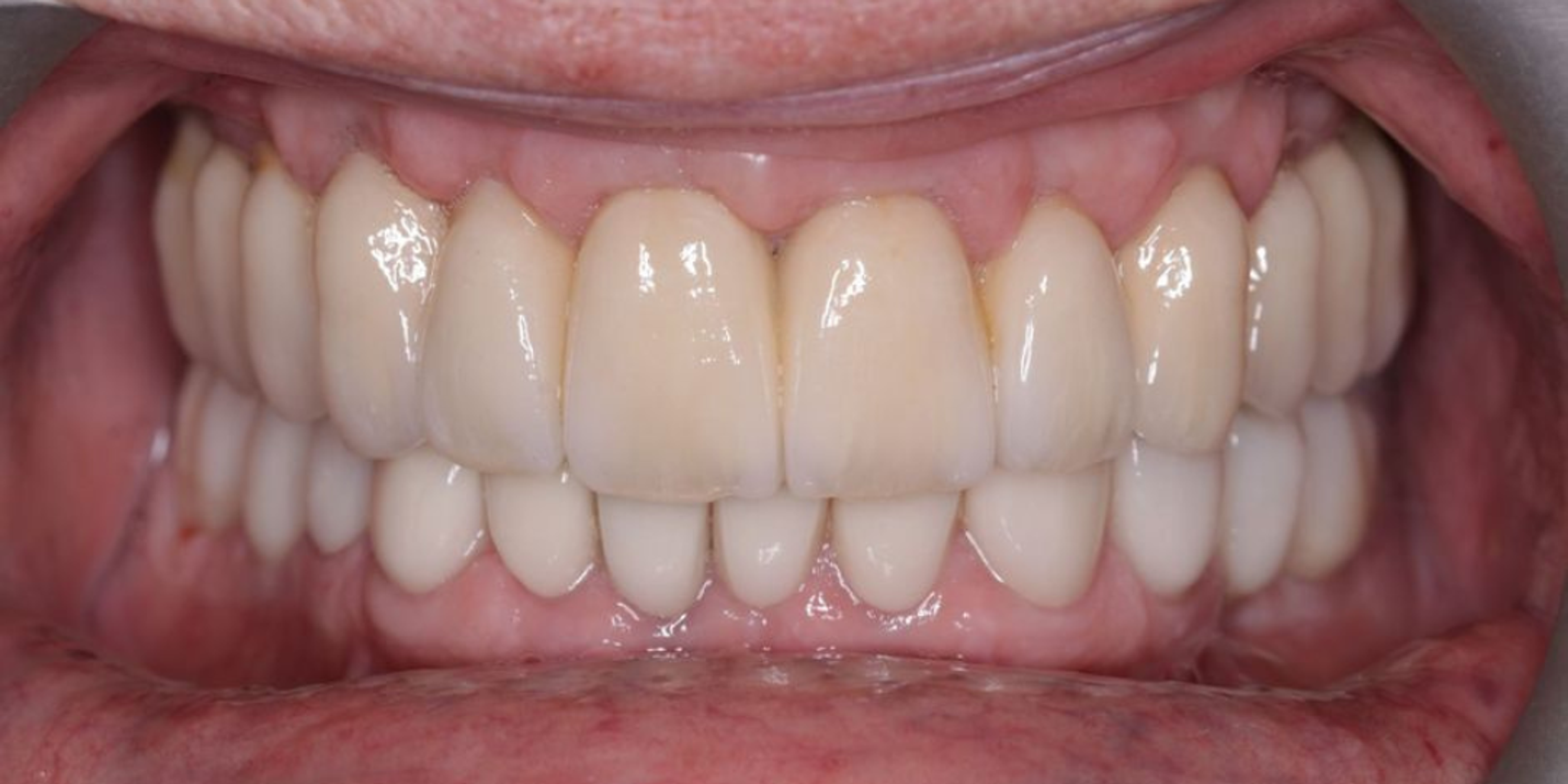 Image showing front teeth in patients mouth after implant treatment with very natural results