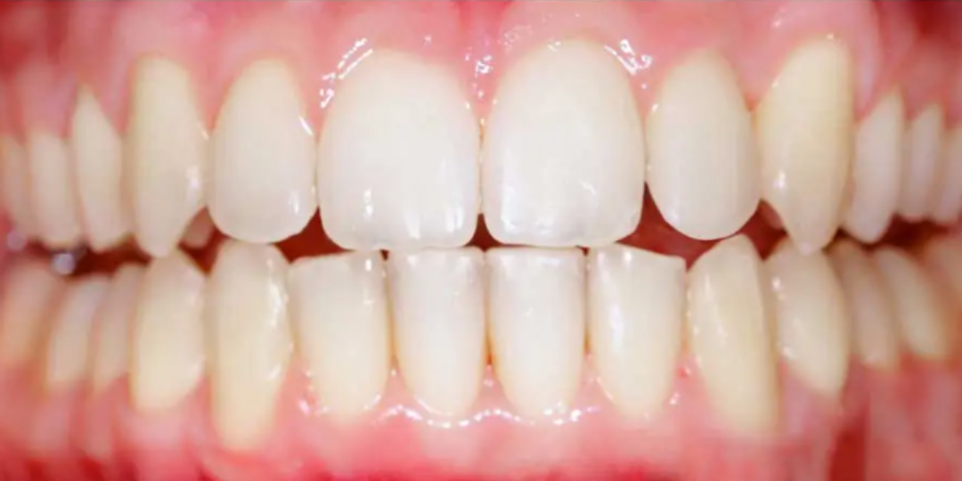 Invisalign after