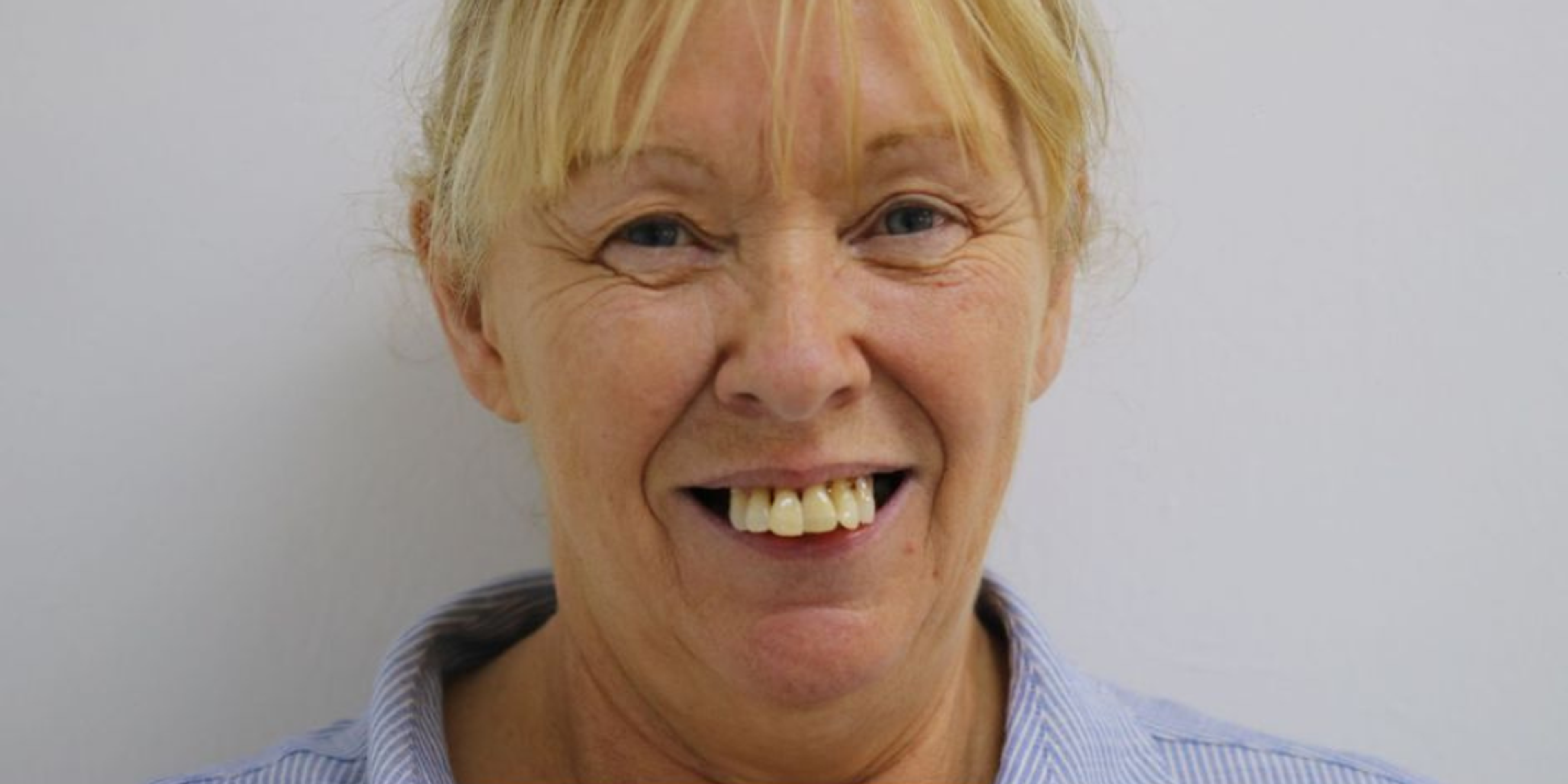 Before dental implant treatment showing severe periodontal disease missing teeth and decay