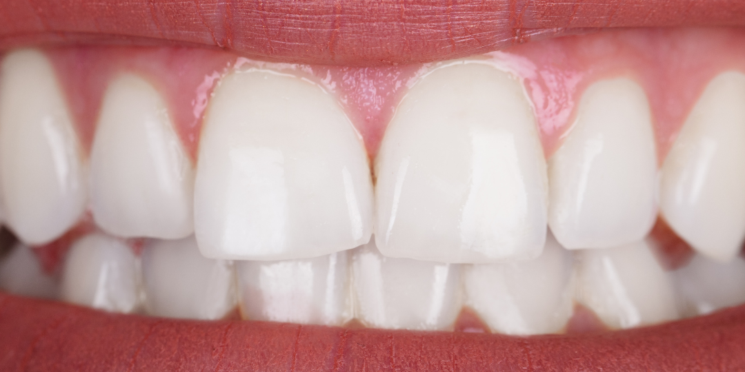 teeth whitened after treatment results