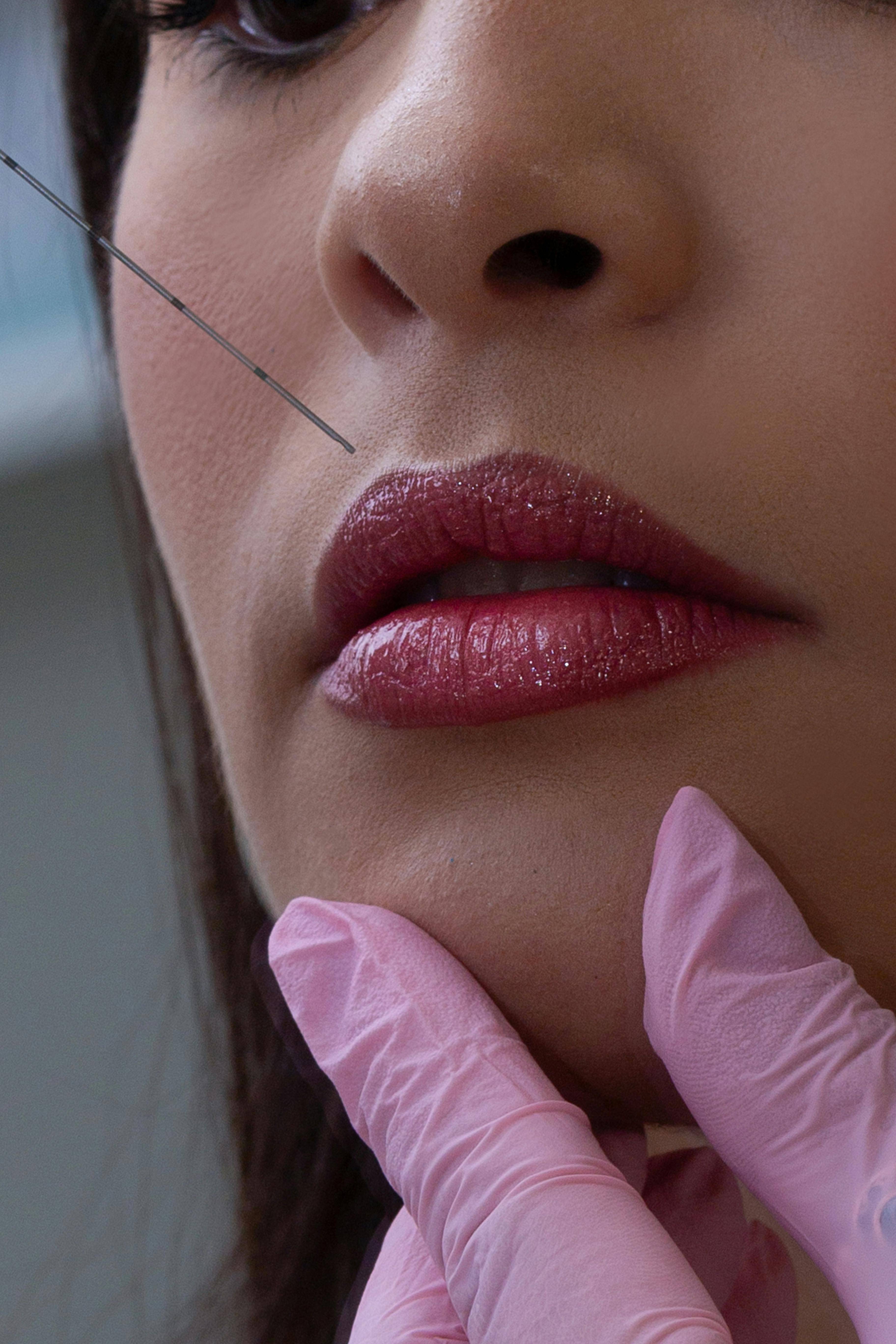 patient having lip filler at dental surgery