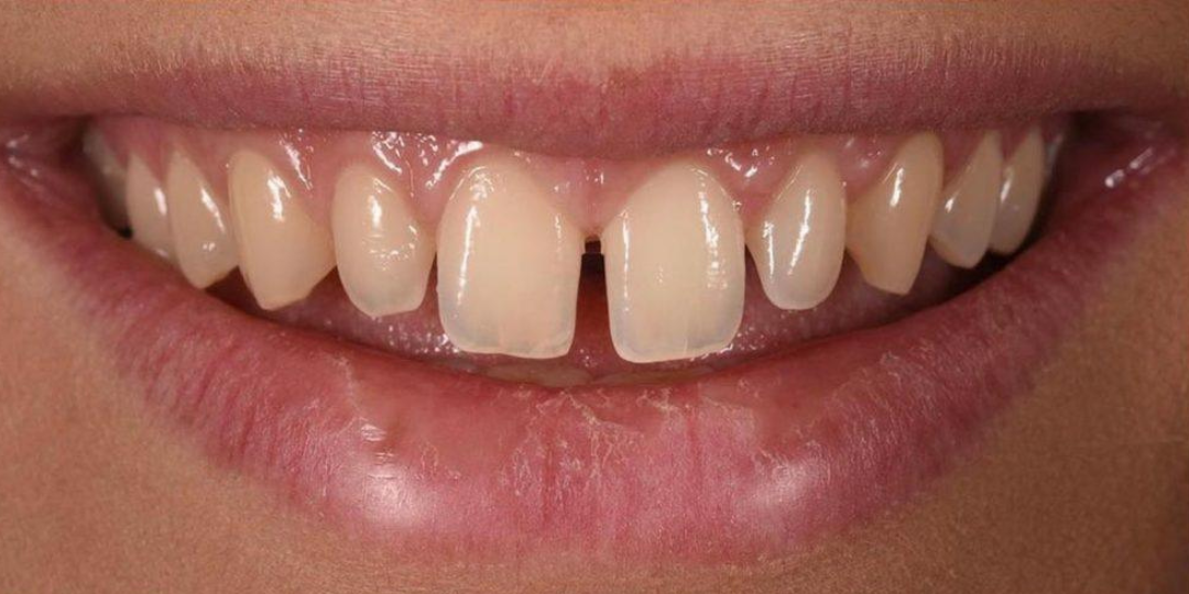 veneer bridge before