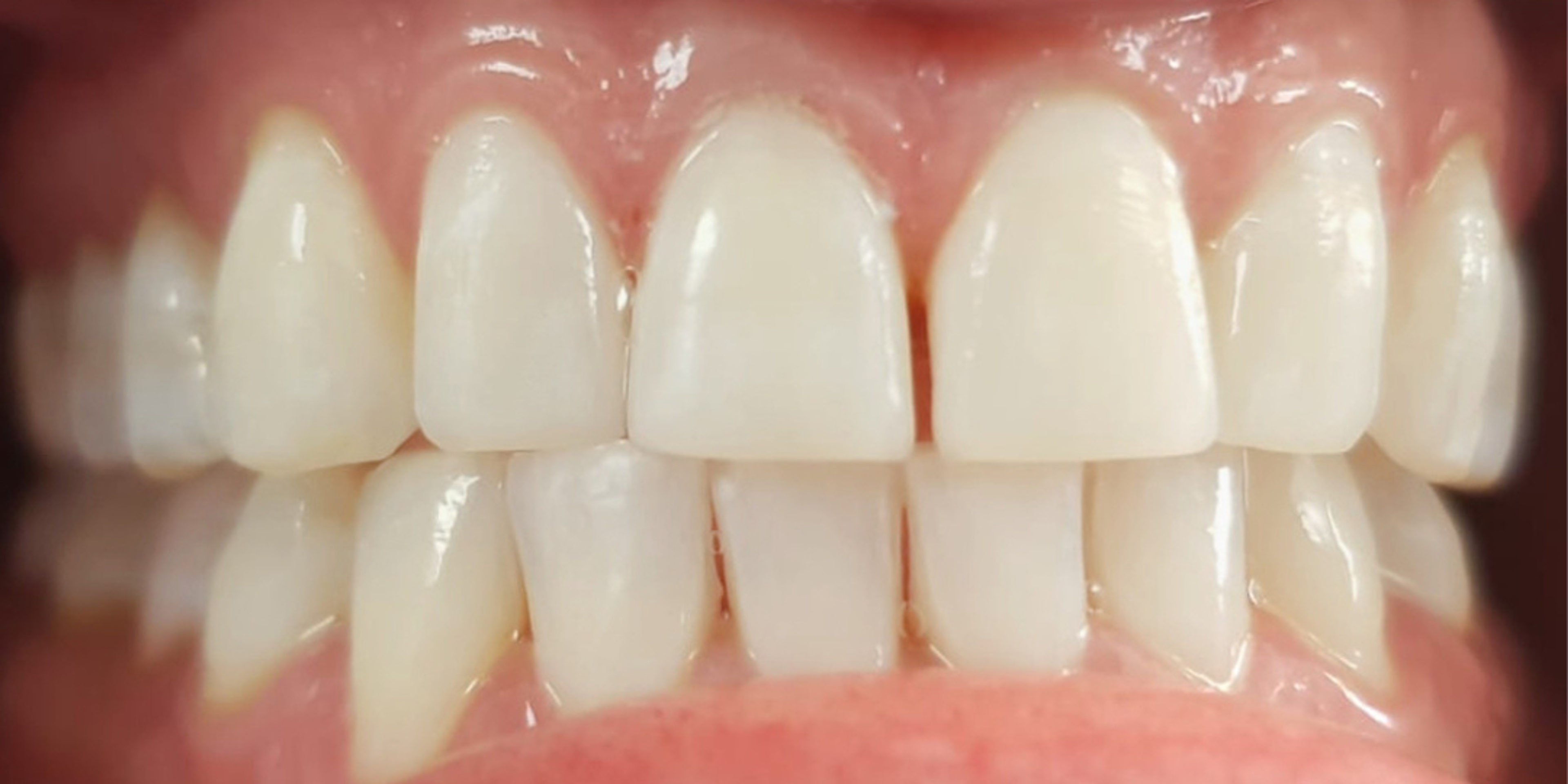 teeth whitened after treatment results