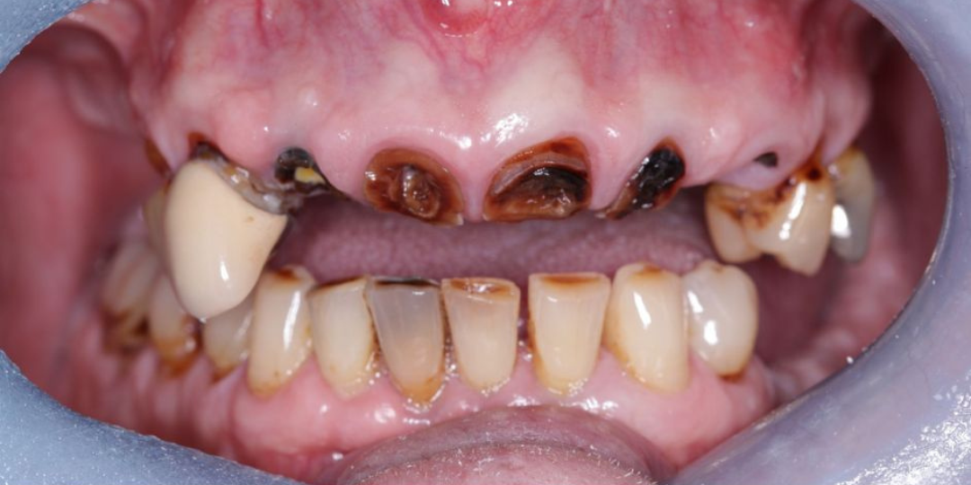 Image showing front teeth in patients mouth broken missing tooth before implant treatment