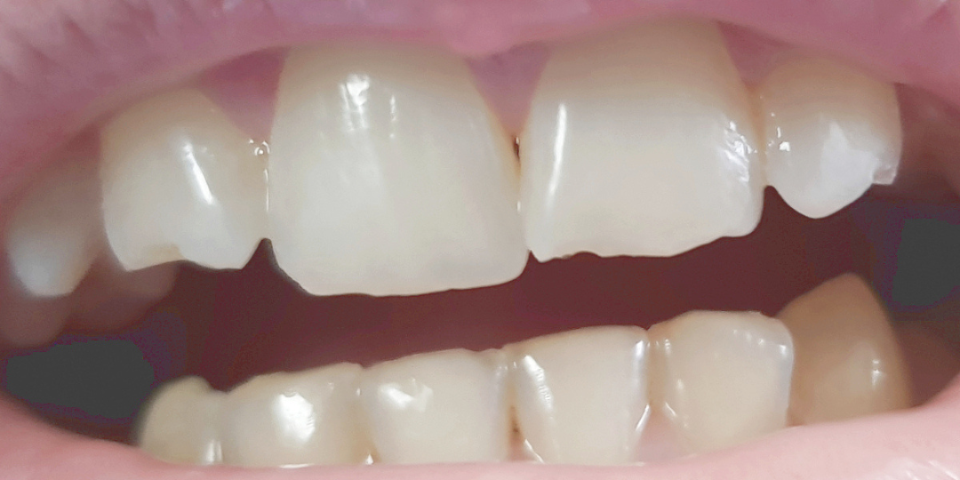 composite bonding case before