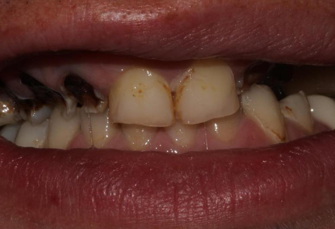 veneer bridge before