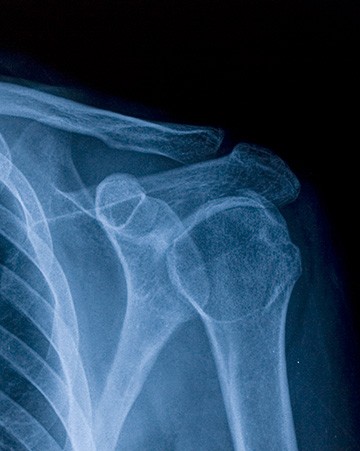 RCSI news image for Multi-functional material designed to boost bone healing
