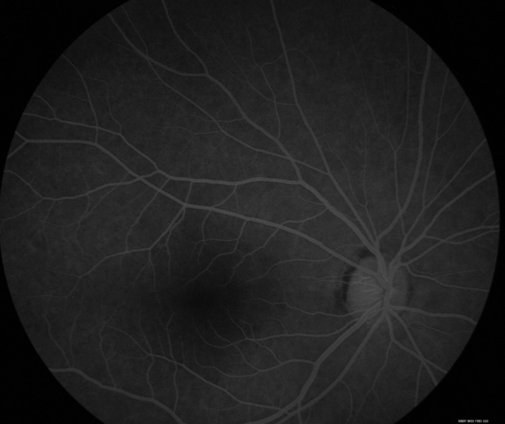 Fluorescein imaging of the retinal vasculature