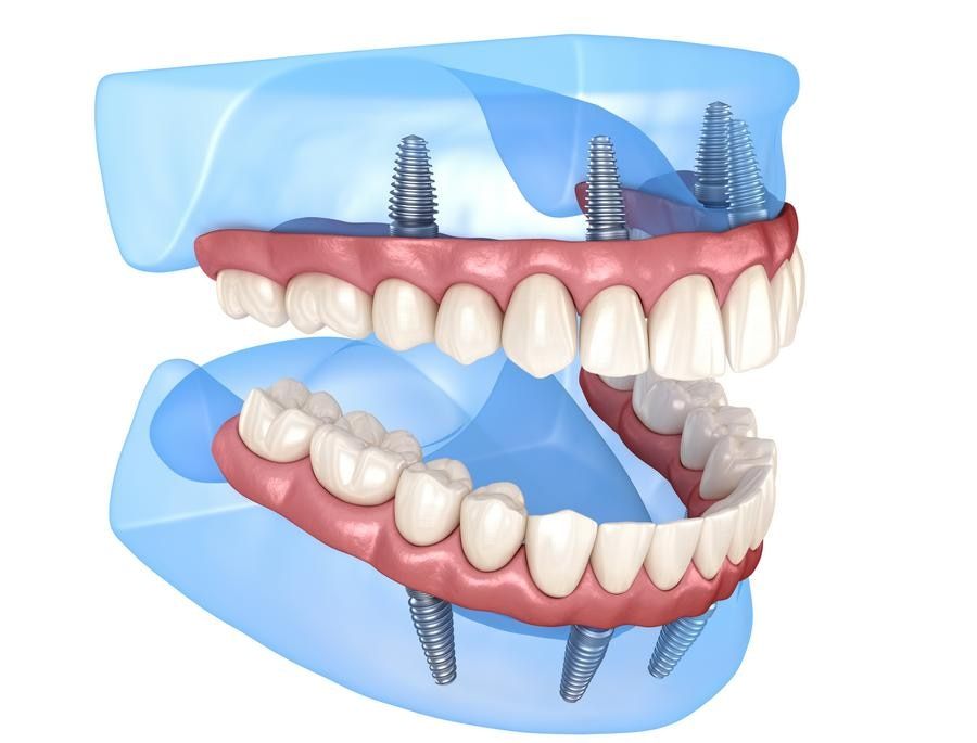 All on 4 dental implant system. Medically accurate 3D illustration of human teeth and implants See Ghadiri Dental in San Jose for All on 4