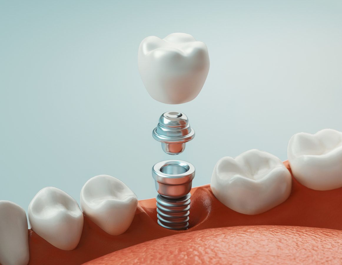 dental implant