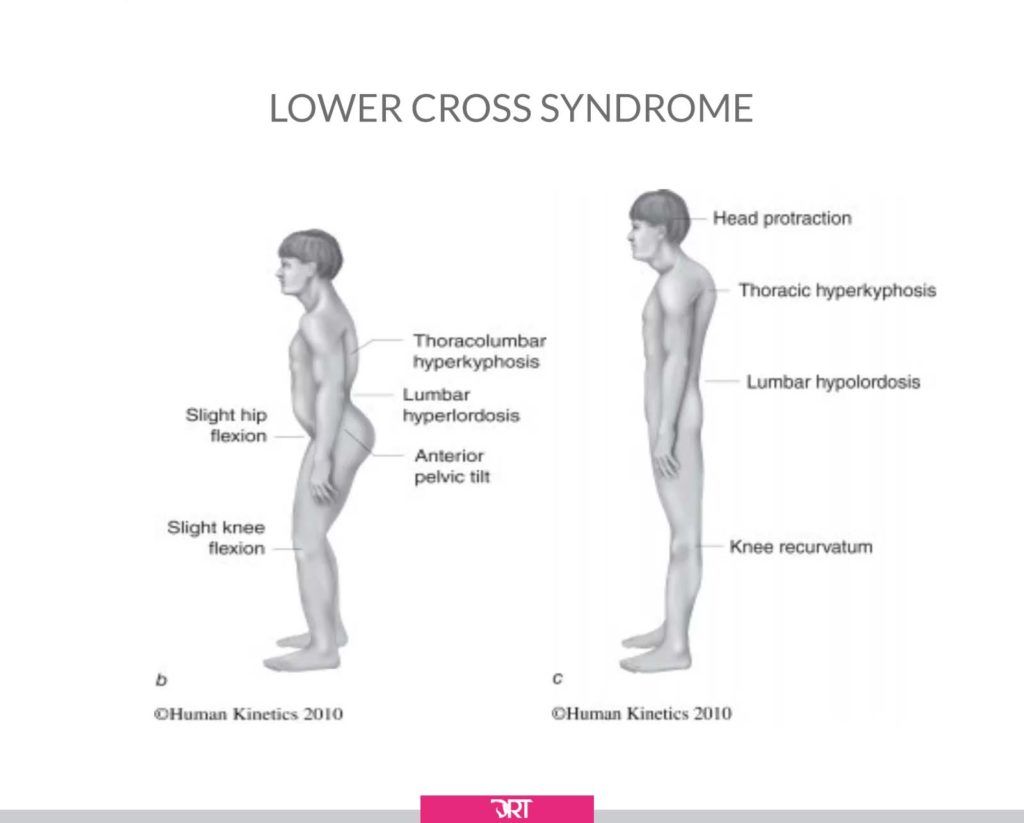 lower cross syndrome
