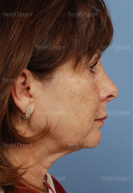 Facelift before, case 2666
