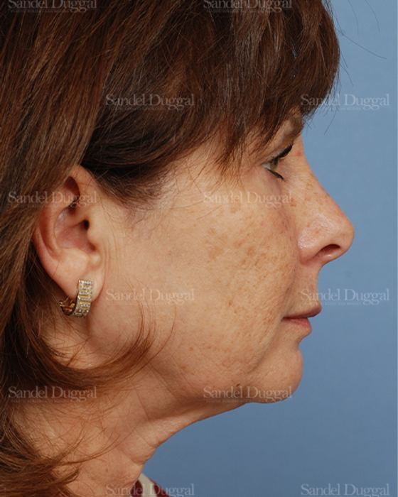 Facelift before, case 2666