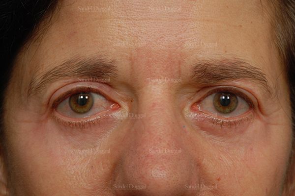 Eyelid Rejuvenation after, case 1943