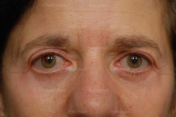 Eyelid Rejuvenation after, case 1943