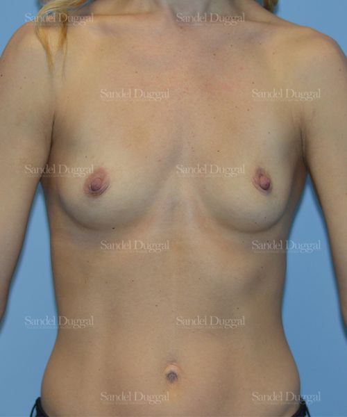 Breast Augmentation before, case 3199