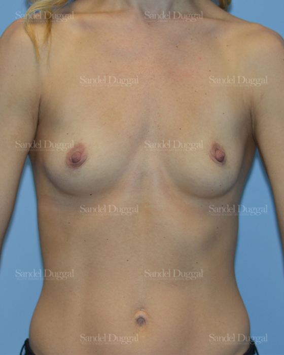 Breast Augmentation before, case 3199