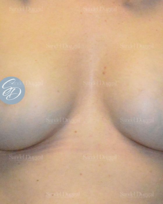Liposuction — Bra Roll after, case 2489