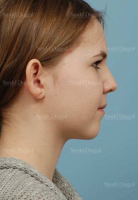Otoplasty before, case 2598