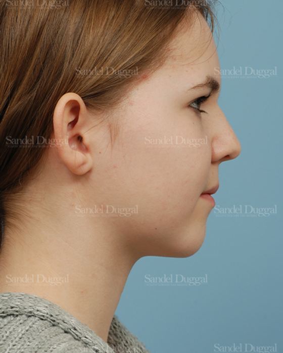 Otoplasty before, case 2598