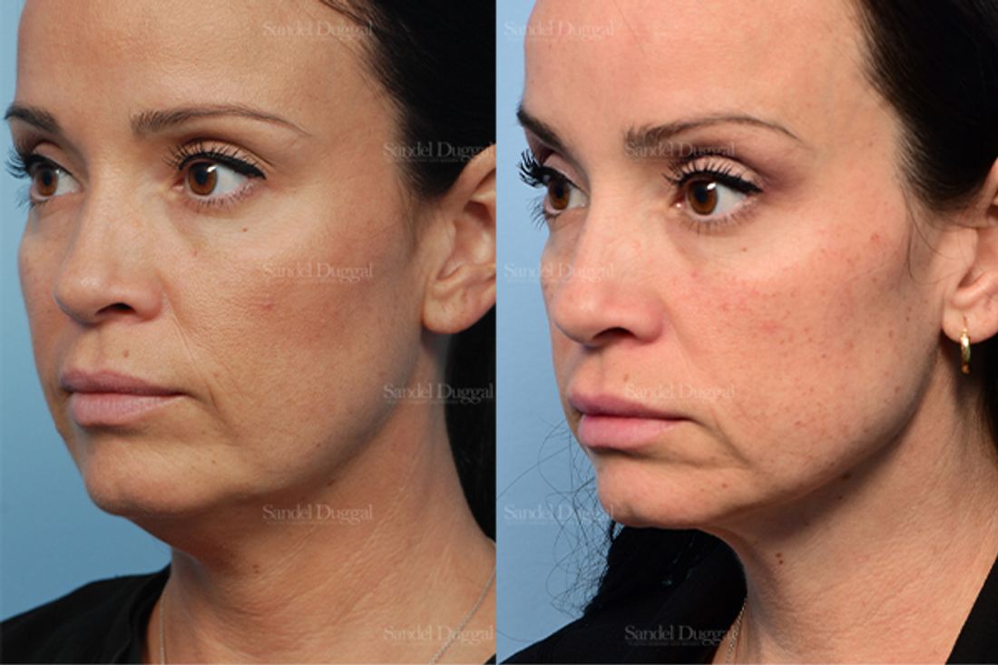 Neck & Chin Liposuction before and after, case 2554