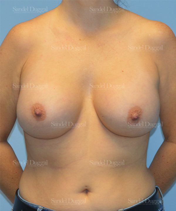 Breast Augmentation after, case 778