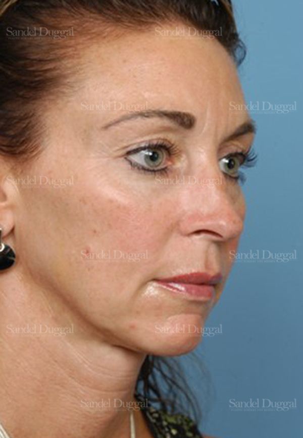 Chin Augmentation before, case 1484