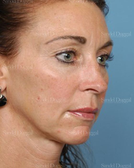 Chin Augmentation before, case 1484