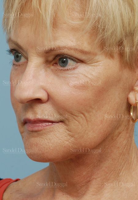 Laser Skin Resurfacing after, case 2958