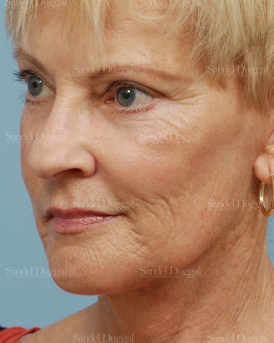 Laser Skin Resurfacing after, case 2958