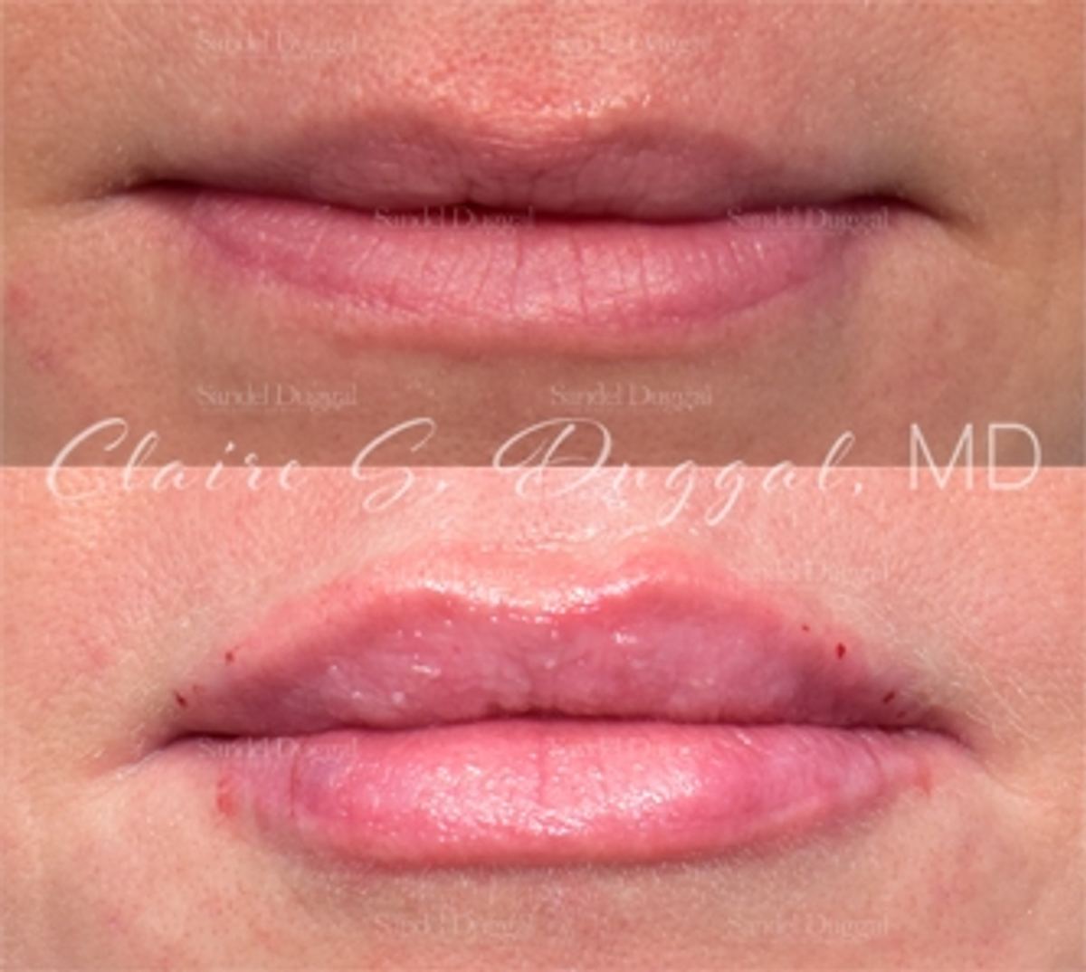 Lip Augmentation / Lip Lift before and after, case 5294