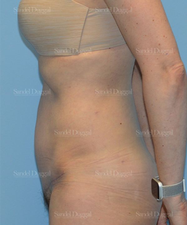 Tummy Tuck after, case 1652