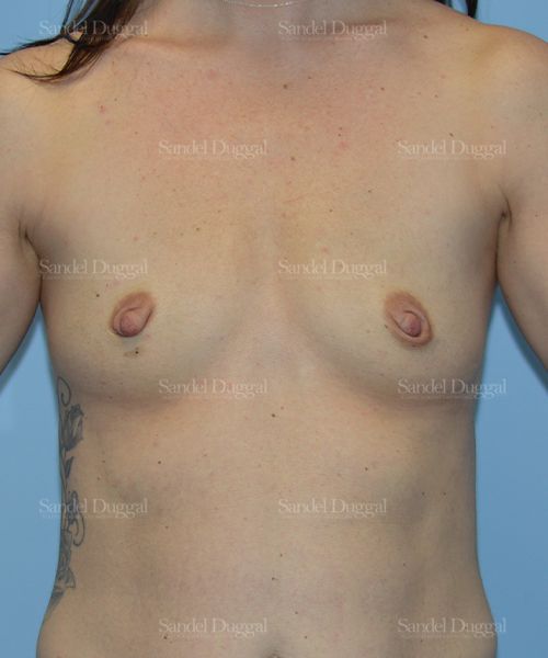 Breast Augmentation before, case 3178