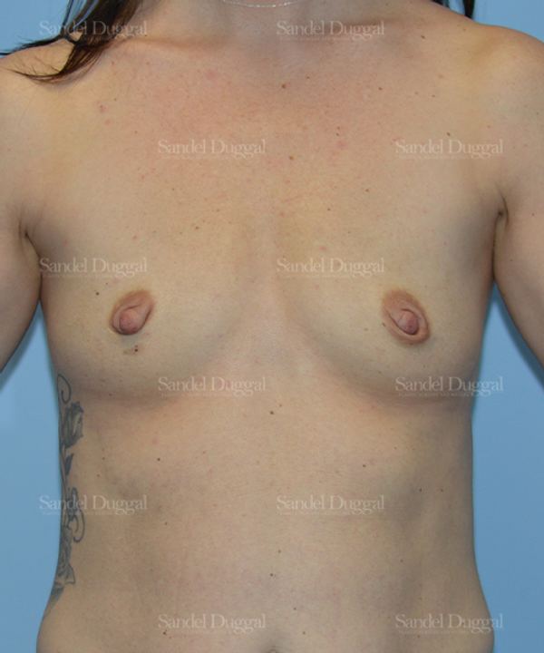 Breast Augmentation before, case 3178