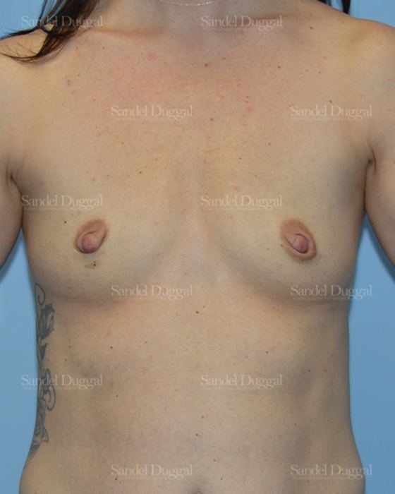 Breast Augmentation before, case 3178