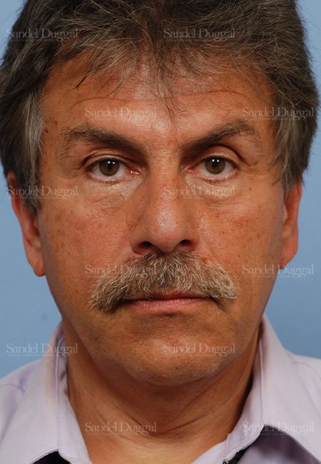 Facelift before, case 2719
