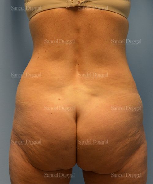 Tummy Tuck before, case 1599