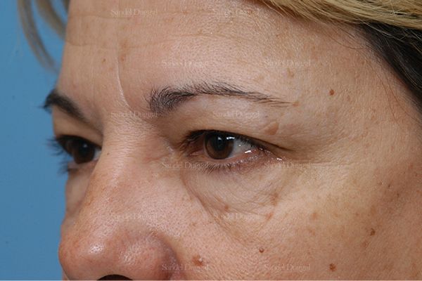 Eyelid Rejuvenation before, case 1900