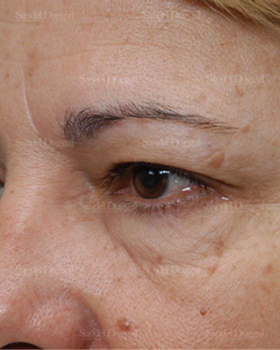 Eyelid Rejuvenation before, case 1900