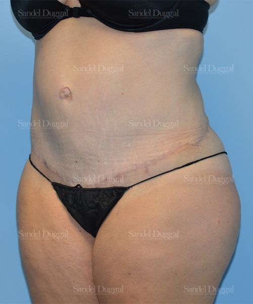 Tummy Tuck after, case 1673